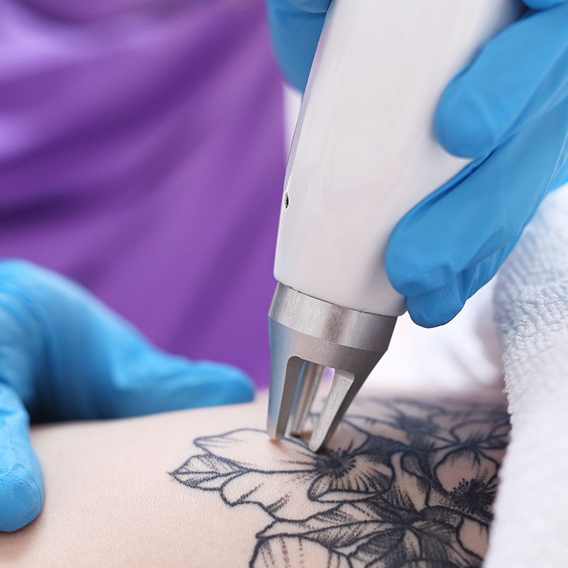 Laser Tattoo Removal in Winchester