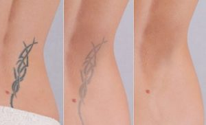Tattoo Removal Winchester