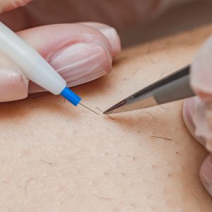 The,Process,Of,Permanent,Hair,Removal,,Removing,Unwanted,Hair,Using